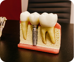 maqueta de implantes de dientes