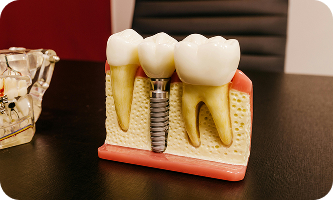 maqueta de implantes dentales